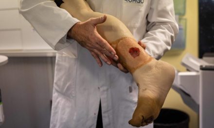 Dressing ‘revolution’ seeks artificial skin for burn victims